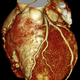 Illustration for article titled Brilliance CT 256-Slice Scanner from Philips Gets to the Heart of the Problem